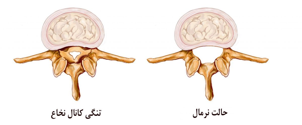علائم تنگی کانال نخاعی چیست؟
