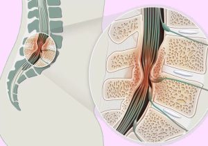 تنگی کانال نخاعی چیست؟