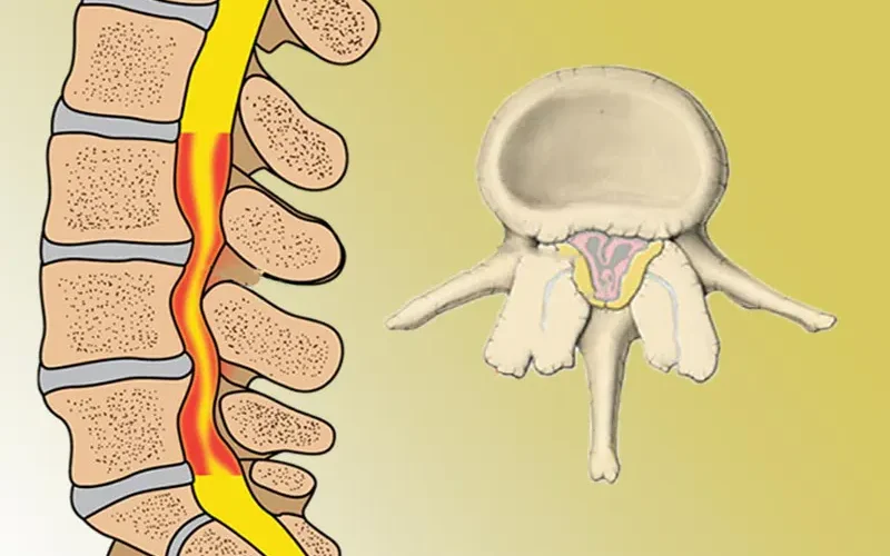 تنگی کانال نخاعی چیست؟