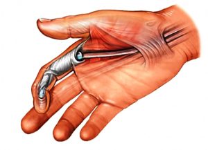 فیزیوتراپی تاندون انگشت شست دست