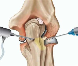 آرتروسکوپی زانو
