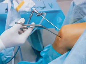 مزایای آرتروسکوپی زانو