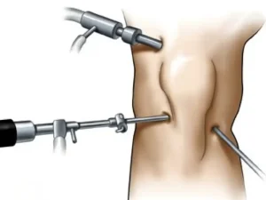 آرتروسکوپی زانو