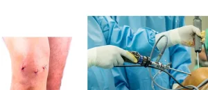 مزایای آرتروسکوپی زانو