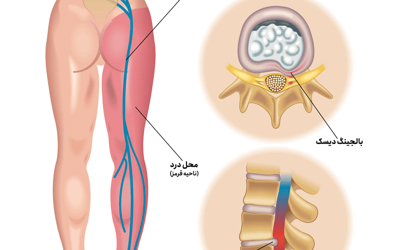 اعصاب ناحیه خاجی (ساکرال) چیست؟