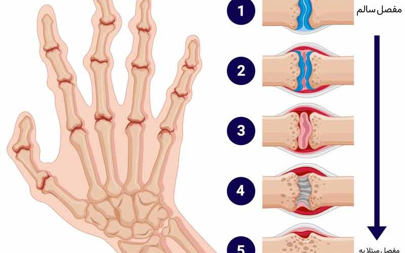 درمان زودهنگام روماتیسم