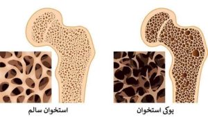 علل ابتلا به پوکی استخوان