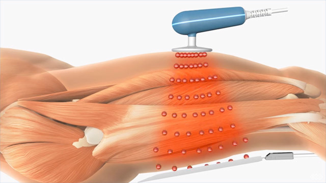 تکار تراپی در رشت؛ راهکاری مدرن برای بازسازی سریع بافت و کاهش درد