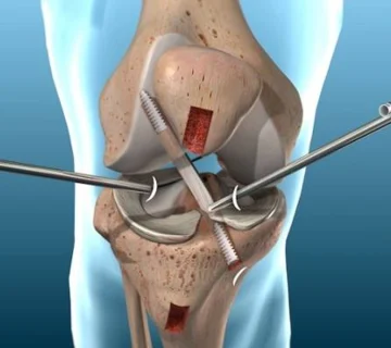 آرتروسکوپی زانو