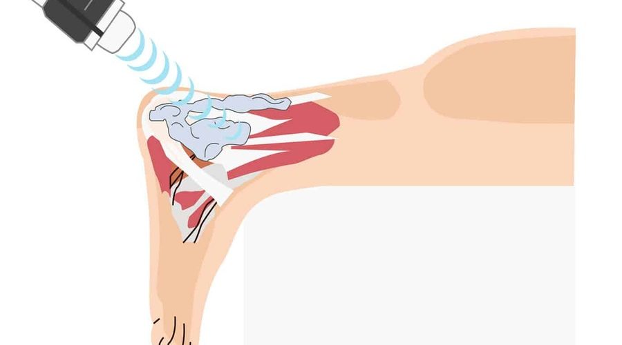 شاک ویو تراپی در رشت؛ درمان سریع درد و التهاب بدون جراحی