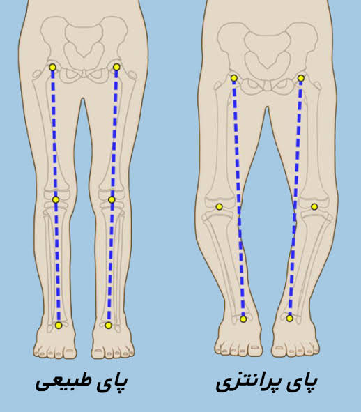 تمرینات اصلاحی برای پای پرانتزی؛ آیا قابل درمان است؟