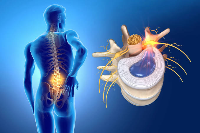 تفاوت سیاتیک با دیسک کمر؛ چگونه تشخیص دهیم؟