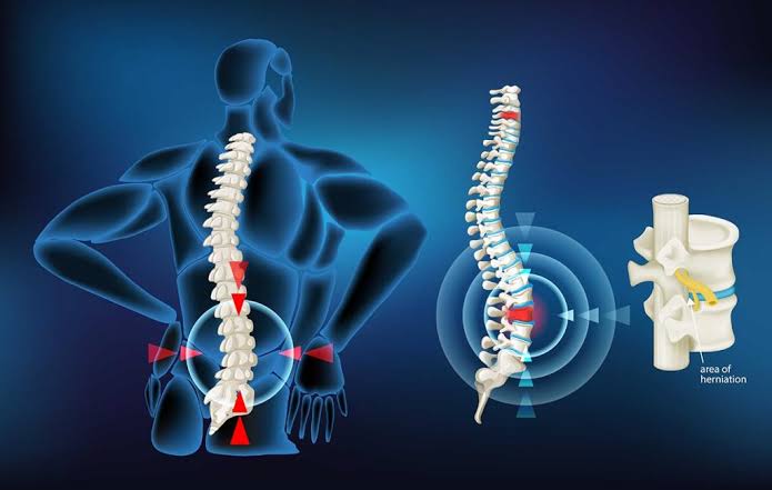 تفاوت سیاتیک با دیسک کمر؛ چگونه تشخیص دهیم؟