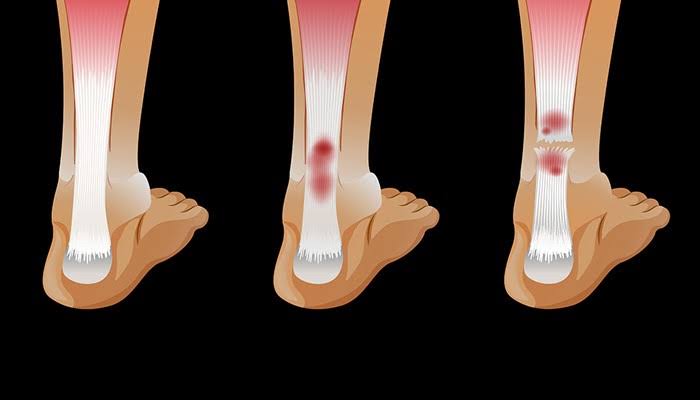 فیزیوتراپی مچ پا بعد از پیچخوردگی؛ مراحل تا بازگشت به ورزش