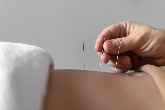 طب سوزنی در کنار فیزیوتراپی در رشت؛ مکملی برای تسریع درمان