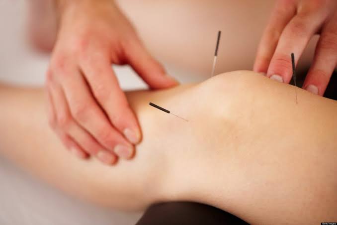 طب سوزنی در کنار فیزیوتراپی در رشت؛ مکملی برای تسریع درمان