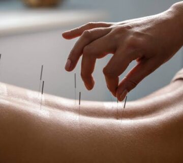 طب سوزنی در کنار فیزیوتراپی در رشت؛ مکملی برای تسریع درمان