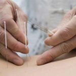طب سوزنی در رشت برای رفع جای جوش و زخم؛ واقعیت یا تبلیغ؟