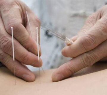 طب سوزنی در رشت برای رفع جای جوش و زخم؛ واقعیت یا تبلیغ؟