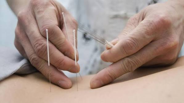طب سوزنی در رشت برای رفع جای جوش و زخم؛ واقعیت یا تبلیغ؟