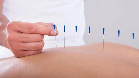 طب سوزنی در فیزیوتراپی در رشت؛ چگونه درد را کاهش می‌دهد؟