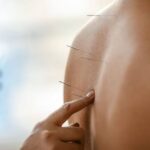 طب سوزنی در فیزیوتراپی در رشت؛ چگونه درد را کاهش می‌دهد؟