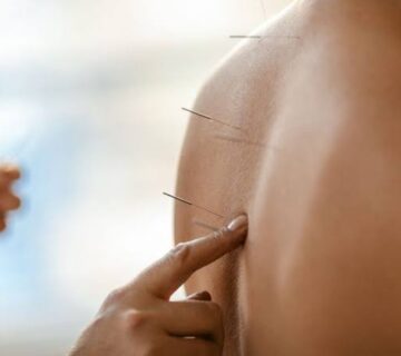 طب سوزنی در فیزیوتراپی در رشت؛ چگونه درد را کاهش می‌دهد؟