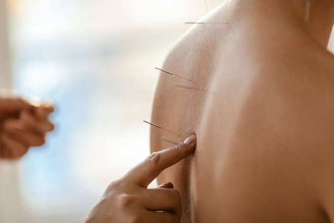 طب سوزنی در فیزیوتراپی در رشت؛ چگونه درد را کاهش می‌دهد؟