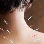 طب سوزنی در رشت برای کمردرد و گردن‌درد مزمن مؤثر است؟