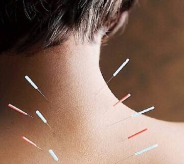طب سوزنی در رشت برای کمردرد و گردن‌درد مزمن مؤثر است؟
