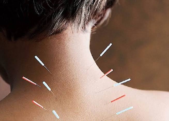 طب سوزنی در رشت برای کمردرد و گردن‌درد مزمن مؤثر است؟
