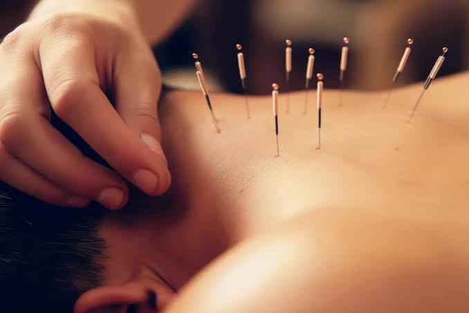 طب سوزنی در رشت برای کمردرد و گردن‌درد مزمن مؤثر است؟
