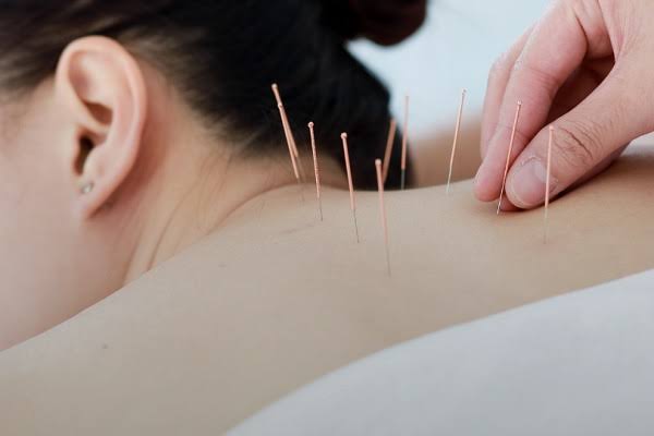 طب سوزنی در رشت برای کمردرد و گردن‌درد مزمن مؤثر است؟