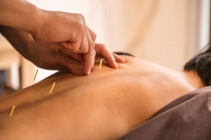 تفاوت طب سوزنی سنتی و طب سوزنی در فیزیوتراپی مدرن در رشت