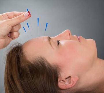 تفاوت طب سوزنی سنتی و طب سوزنی در فیزیوتراپی مدرن در رشت