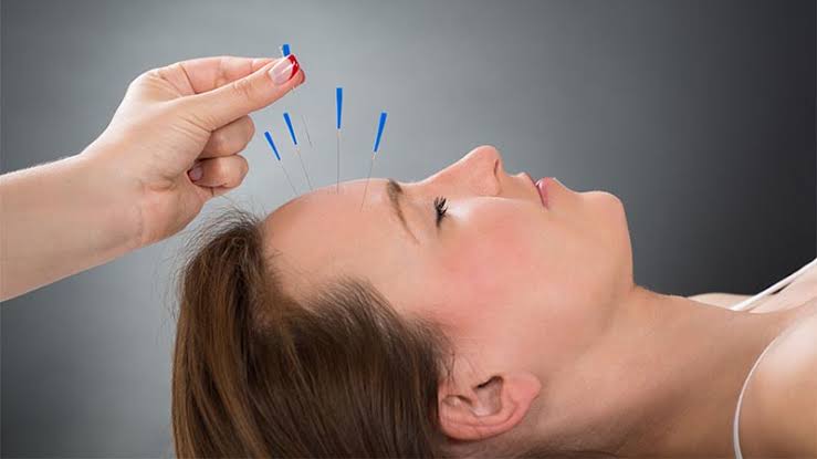 تفاوت طب سوزنی سنتی و طب سوزنی در فیزیوتراپی مدرن در رشت