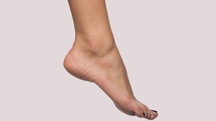 افتادگی پا چیست؟ علل احتمالی و نقش توان‌بخشی در رشت در راه رفتن